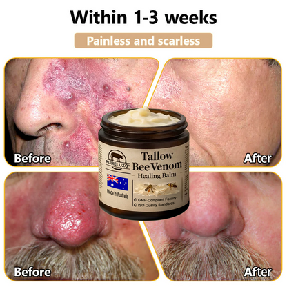 【70% OFF Wraps Up Today】Pureluxo® 🐄Tallow Bee Venom Healing Balm（Sorts Out Spots, Wrinkles & Knackered Skin — Steroid-Free）