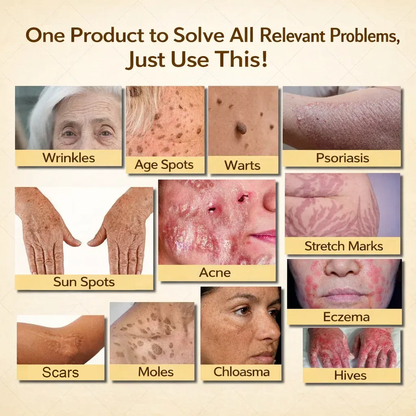 【70% OFF Wraps Up Today】Pureluxo® 🐄Tallow Bee Venom Healing Balm（Sorts Out Spots, Wrinkles & Knackered Skin — Steroid-Free）