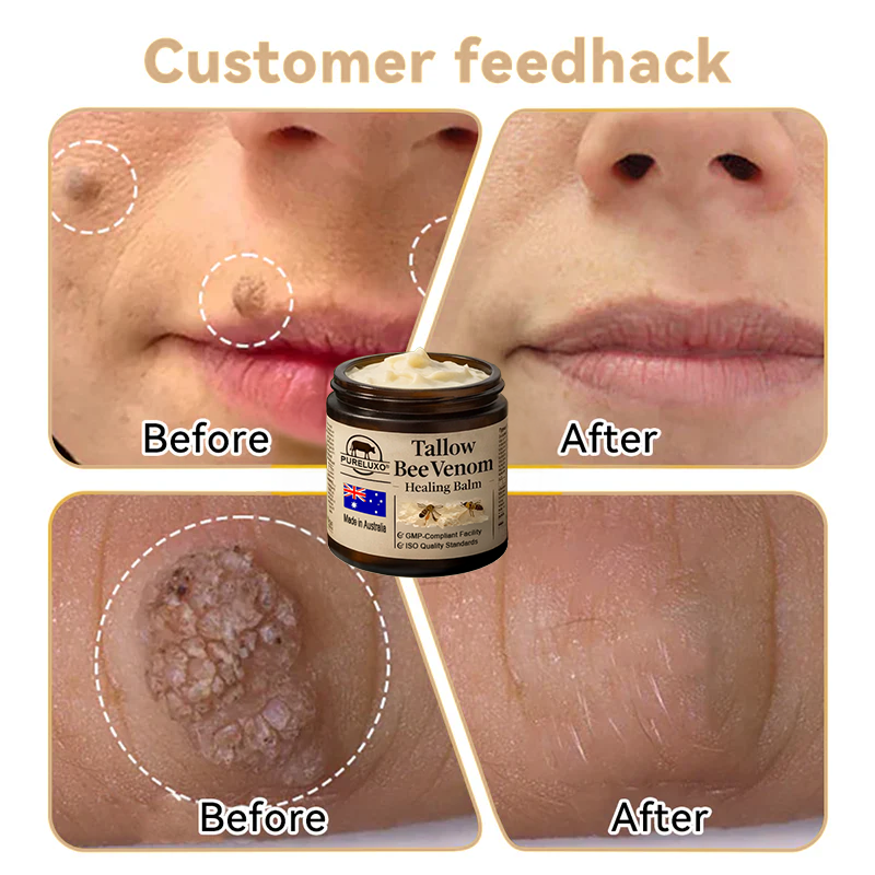 【70% OFF Wraps Up Today】Pureluxo® 🐄Tallow Bee Venom Healing Balm（Sorts Out Spots, Wrinkles & Knackered Skin — Steroid-Free）