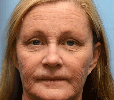 (Made and Shipped from USA) 🧑‍⚕️ TLOPA® Botox Bee Venom Wrinkle Removal Cream- LAST DAY 70% OFF🔥